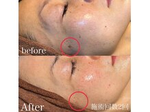 サロンドベル(salon de Belle)の雰囲気（人気沸騰中！施術2回でもシミが変化します【プラズマ】が解決☆）