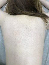 ナノハナ/鹿沼市の全身脱毛のナノハナ