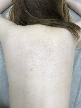 ナノハナ/鹿沼市の全身脱毛のナノハナ