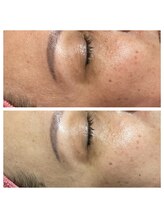 紫檀(シタン)/透明感♪重いまぶた♪目元の疲れ