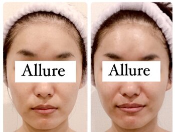 アリュール(Allure)/小顔コルギ（30代女性）