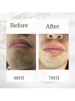 サロン ルイ(salonRui)/ひげ脱毛　before　afuta