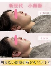 クレビア(CREBIA)/短期間で小顔造形！