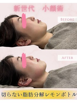 クレビア(CREBIA)/短期間で小顔造形!