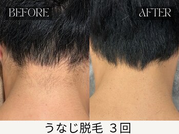 スキンジム(SKIN GYM)/スーツも映えるうなじ脱毛