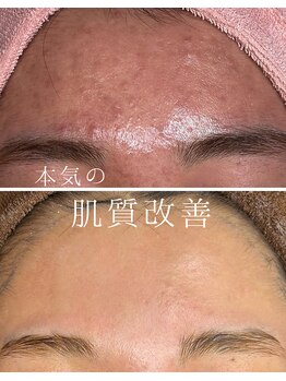 ミハン ボーテ(mihan.beaute)/【ニキビ・赤み】