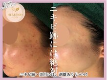 ハーバリー 天王寺(HERBERRY)/ハーブピーリング専門店HERBERRY