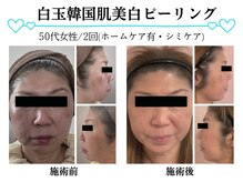 スパイア(SPIRE)/白玉韓国美白ピーリング