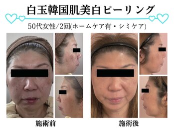 スパイア(SPIRE)/白玉韓国美白ピーリング