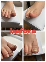 ラピス(Lapis)/巻爪ケア