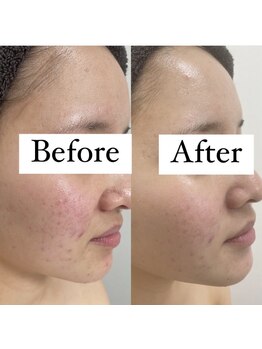 カルディエ(Cardie)/肌質改善　ビフォーアフター