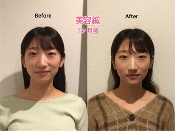 チキバン美容鍼灸整体サロン 心斎橋店/美容鍼（美容針）の経過