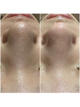 エヌ ドット ジュウイチ(N.11)/毛穴エクストラクション