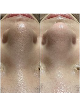 エヌ ドット ジュウイチ(N.11)/毛穴エクストラクション