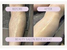 レーヴエクラ(Reve eclat)の雰囲気（自信の持てるつるつや肌へ★綺麗のお手伝いさせていただきます！）