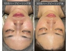 ロッタ エクリュ(Lotta ecru+)/REVI剥けないハーブピーリング