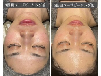 ロッタ エクリュ(Lotta ecru+)/REVI剥けないハーブピーリング