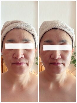 ジフィー(Gify)/筋膜リリースカッターFacial