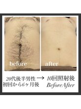 エリクサー 熊谷店(Elixir)/20代後半10回照射後