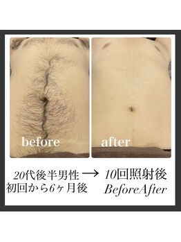 エリクサー 熊谷店(Elixir)/20代後半10回照射後