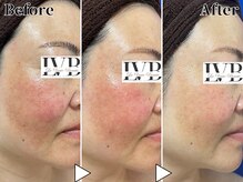 ラヴレボーテ(La Vraie Beaute)/40代・シミ 赤み・改善期間1ヶ月