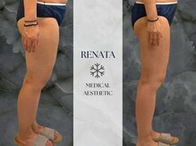 レナータ 六本木(RENATA)/【脂肪冷却】経過写真