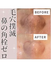 エステティック エイチアンドビー 大和店(H&B)/毛穴　フェイシャル