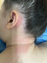 ジーワックス(G WAX)/恵比寿脱毛《うなじ》