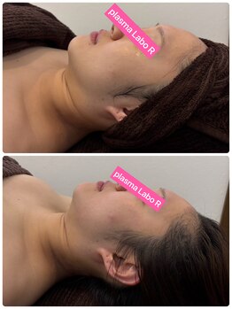 アール(R)/【 マーメイドセルTM 】