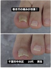 巻き爪じゅん 船橋店/巻き爪による痛みが改善！