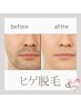 【メンズ脱毛】毎日の髭剃りを楽に♪ヒゲ脱毛 ☆