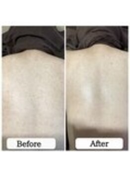 ル ボヌール 伊那店(le bonheur)/背中の美肌ケア