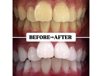 ホワイトニングサロン 豊中/Before&After美白ホワイトニング
