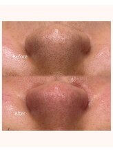 レア(Lea)/さよなら、いちご鼻！