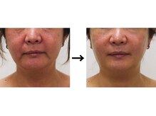 ドクターエイジレス(DR.AGELESS)/バイオセルショットコース6回