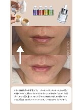 ミーツ(Meets)/ホルモンの影響でニキビが…