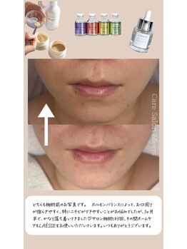 ミーツ(Meets)/ホルモンの影響でニキビが…