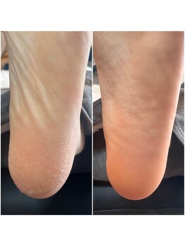 アモット(Amout)/ドイツ式足裏角質ケア