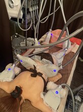 ブルースター(Blue Star)/脂肪冷却8カップ施術風景