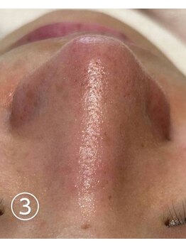 ビアンカーラ(Biancara)/【韓国式3D毛穴洗浄】施術後