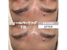 眉間の深いシワが改善！！１回のサロンケアでここまではすごい！