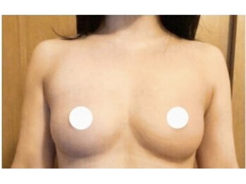 リノ 行橋(lino)/◇バストアップ症例◇