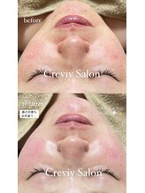 クレヴィー(Creviy)/韓国式3D毛穴洗浄×ハーブ