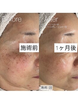 イリス(Iris)/30代以降は色素沈着のリスク回避