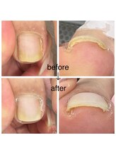 カラーホリック ネイルスパ(Colorholic Nailspa)/巻き爪補正