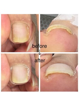 カラーホリック ネイルスパ(Colorholic Nailspa)/巻き爪補正