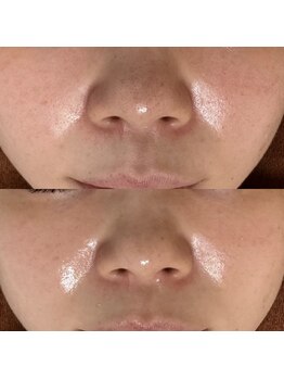 スキニティ(Skinity)/Reviハーブピーリング１回