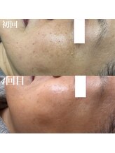 コリー(Kolly)/シミケア