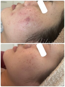 エルール トータルビューティ(Aileure total beauty)/最先端のVOSハーブピーリング