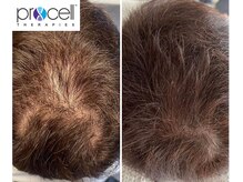 ロティス(LOTIS)/プロセルセラピーズ◆頭皮ケア